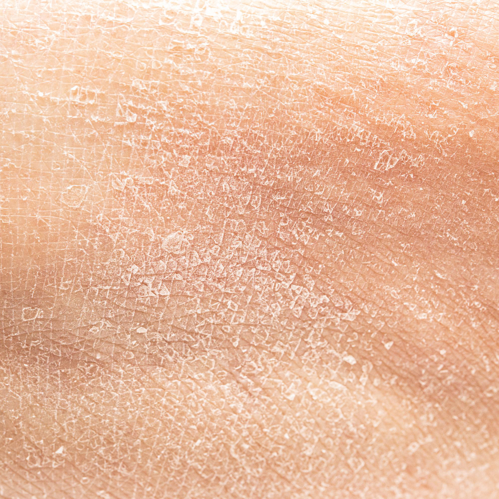 Atopic Skin Conditions